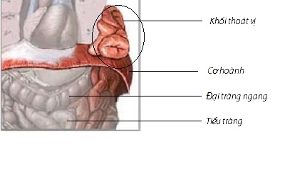 Ảnh 3 của Diaphragmatic hernia